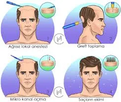 Greft Planlama ve Kapasitesi