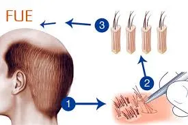 Saç Ekimi Teknikleri FUE (Foliküler Ünite Ekstraksiyonu), DHI (Direct Hair Implantation) Safir FUE